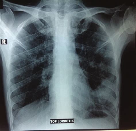 apicolordotic view fit to work|Chest radiographs (a) apicolordotic view revealed fibrotic .